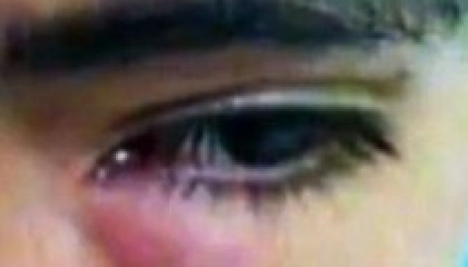 Háromcentis lárvát vettek ki egy fiú szeméből