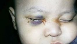 Egészséges szemét távolították el a kisfiúnak, megvakították