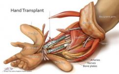 Hamarosan Romániában is végezhetnek kézátültetést