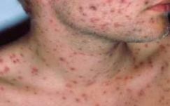 Kanyaróveszélyre figyelmezteti Európát a WHO