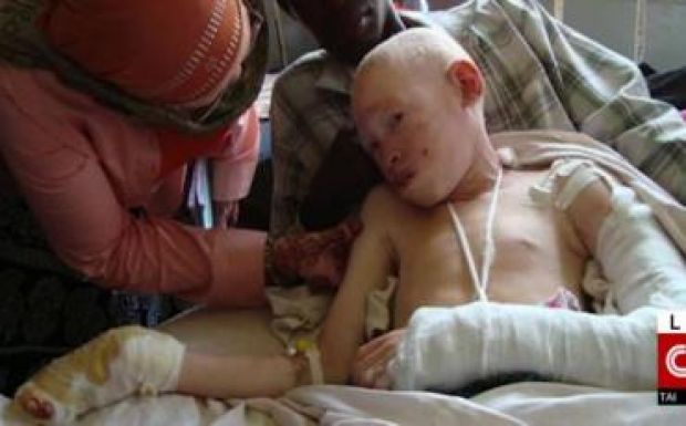 Halálos veszélyben vannak az afrikai albínók a választások miatt