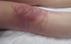 Belehalt a medúzacsípésbe egy német turista Thaiföldön