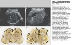 Tudományos bizonyítékot találtak a zikavírus és a kisfejűség között