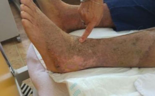 Betegellátás Romániában: újabb lárvás eset került napvilágra