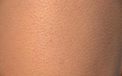 A beteg saját sejtjeiből növesztett bőrt ültettek át Spanyolországban