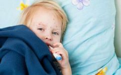 Újabb 33 gyerek betegedett meg kanyaróban