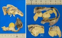 Tumorba ágyazott miniatűr agyat találtak egy japán lánynál