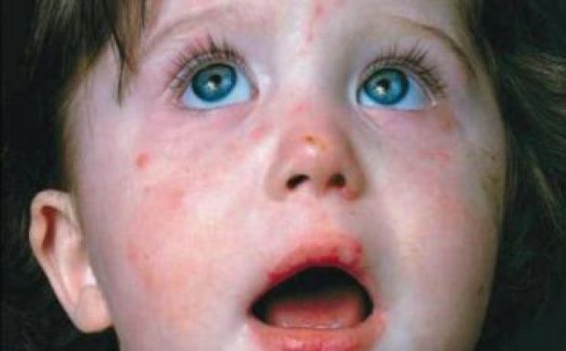 Már tizenhatan haltak meg a terjedő kanyarójárvány miatt