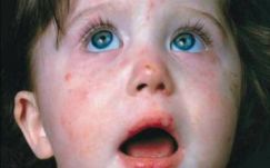 Már tizenhatan haltak meg a terjedő kanyarójárvány miatt