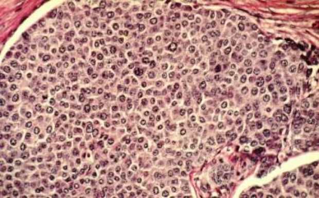 Fontos lépést tettek a magyar kutatók a daganatos betegségek megértése felé