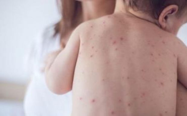 Azt kérik a tévéktől, hogy főműsoridőben népszerűsítsék a kanyaró elleni oltást