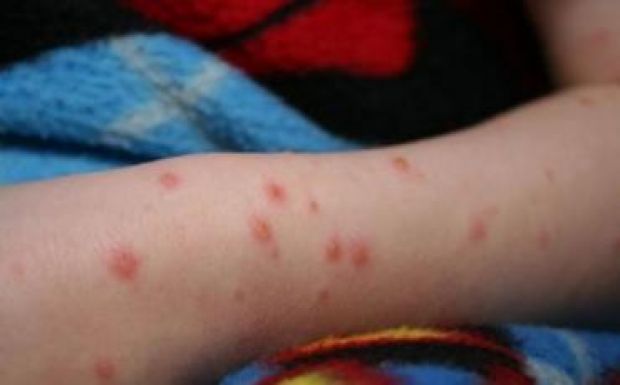 Kanyarójárvány: harmincnál tart a halálesetek száma