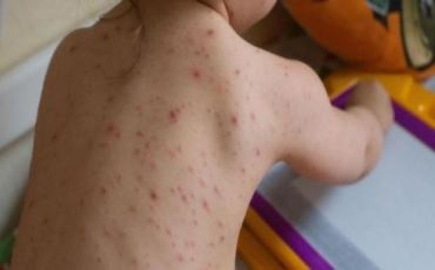 Több mint 800 kanyarós megbetegedést regisztráltak idén Szatmár megyében