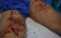 Újabb két embert juttatott kórházba a medve Hargita megyében