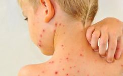 108 újabb kanyarós esetet jegyeztek a héten Romániában