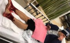 Különös tengeri állatok „harapdálták” meg egy fiatal lábát Ausztráliában