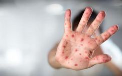 Szinte 8500 kanyarós esetet jegyeztek eddig Romániában