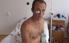 Két órán át műtötték a medvetámadásban megsérült csíkszentléleki férfit