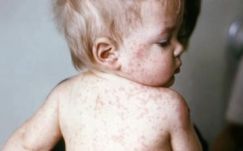 Harmincnégyre emelkedett a kanyaró okozta elhalálozások száma