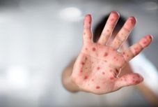 Péntekig országos szinten 9.233 kanyarós megbetegedést regisztráltak