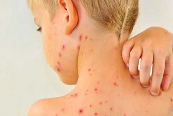 Vakcina van, sokan mégsem oltják be a gyermekeket kanyaró ellen