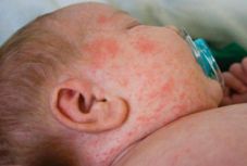 Ismét meghalt egy gyermek kanyaróban