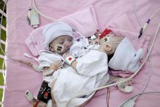 Szétválasztották a gázai sziámi ikreket, az egyik kislány túlélte a műtétet