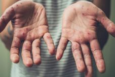 Több százra nőtt a kanyaróval fertőzöttek száma Ukrajnában