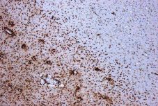 Megtalálták a molekulát, amely a férfiakat a szklerózis multiplextől védheti