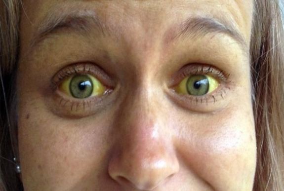 A-típusú hepatitisz gócpont alakult ki Gyergyószentmiklóson