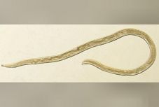 Egy nő fájó szeméből 14 férget távolítottak el