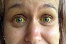 A-típusú hepatitisz gócpont alakult ki Gyergyószentmiklóson