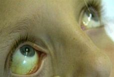 Még tíz személyt kezelnek sárgasággal Gyergyóban