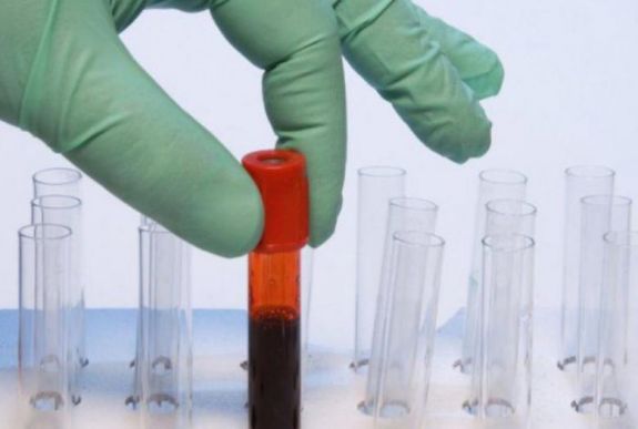 Immunglobulin-hiány: az Egyesült Államok jelezte, hogy van megoldása
