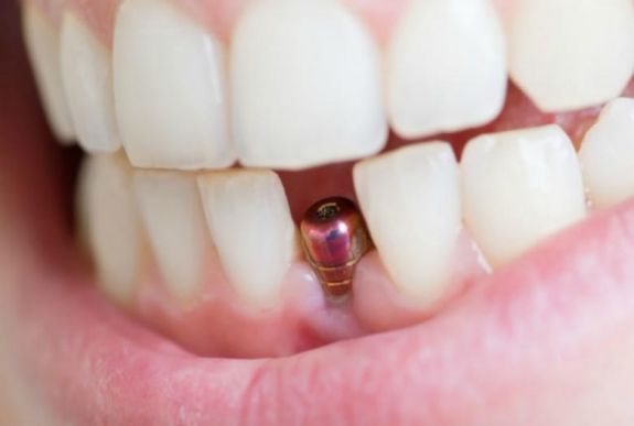 Az életre szóló megoldás – dr. Kiss-Lőrincz Géza a fogászati implantátumokról