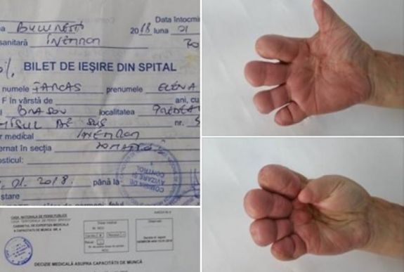 Brassói plasztikai sebész a betegéről: bárcsak amputáltam volna a kezét