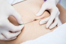 Idén a köldökplasztika a divat