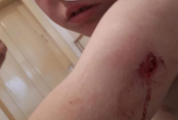 Kilencéves kisfiúra támadt a medve Homoródremeténél