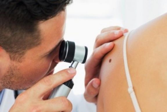 Bőrgyógyász: másfélszeresére nőtt a melanomás esetek száma