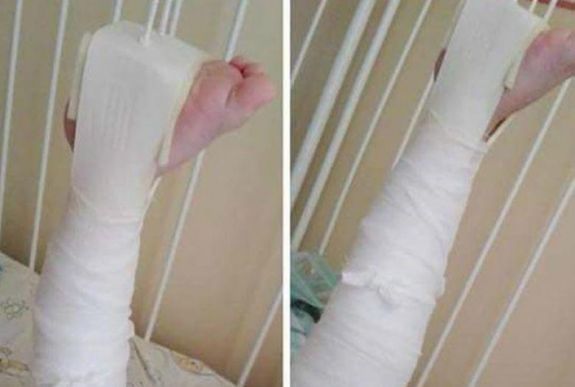 Nem bírta a stresszt a bölcsődei gondozó, eltörte a 2 éves gyermek combcsontját