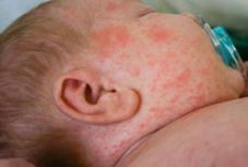 Kanyaró okozta egy háromszéki csecsemő halálát