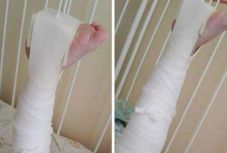 Nem bírta a stresszt a bölcsődei gondozó, eltörte a 2 éves gyermek combcsontját