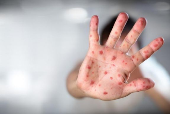 Európában terjedő járványra hívta fel a figyelmet a WHO