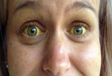 A típusú hepatitisz-gócot azonosítottak a Fehér megyei Felvincen