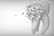 Szakértő: a tejfogaknál is gyakran előfordul fogkopás