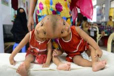 A bangladesi sziámi ikrek szétválasztásán dolgozó magyar orvosok újra remekeltek