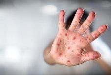 Európában terjedő járványra hívta fel a figyelmet a WHO