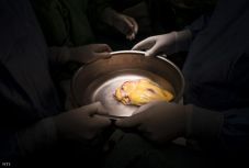 Ugyanattól a szervdonortól lett rákos négy transzplantált beteg