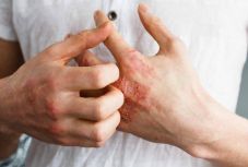 Szinte naponta jönnek ki új gyógyszerek a pikkelysömör enyhítésére