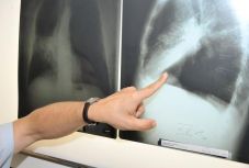 Tüdőrákban halt meg egy nő, akibe egy dohányos tüdejét ültették át